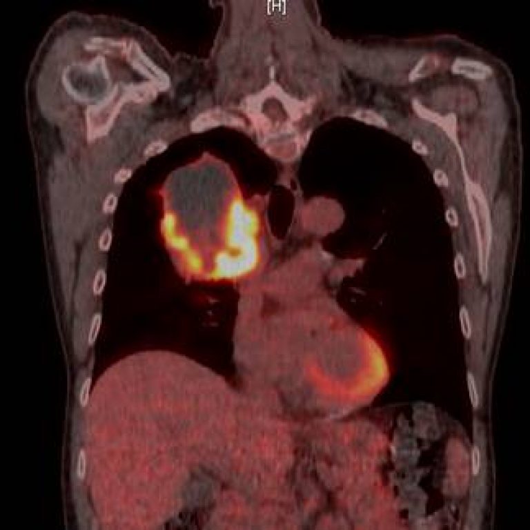 Scan of a pair of lungs