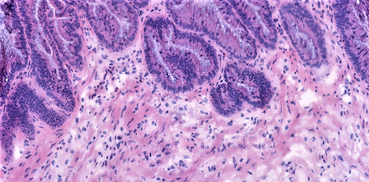 H&E stained section of pseudomyxoma peritonei (PMP)