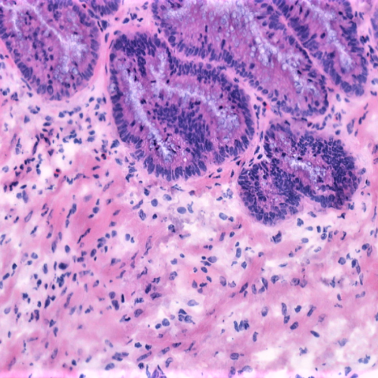 Manchester Cancer Research Centre - Peritoneal Metastases