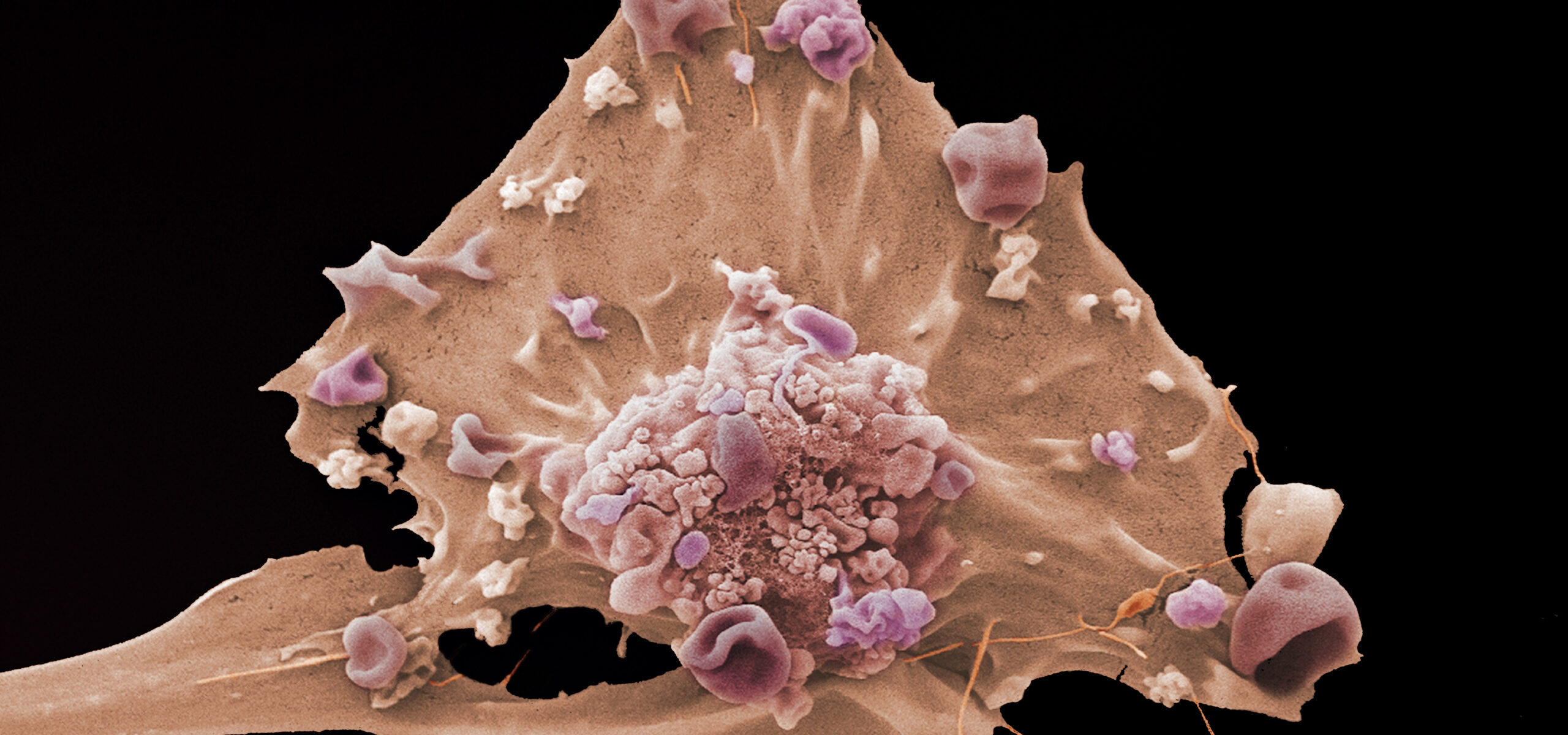 Breast cancer cells
