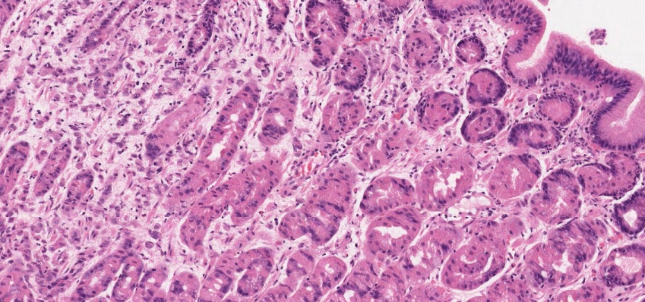 Haematoxylin and eosin stained gastric cancer under the microcope