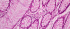 human breast cancer tissue cells stained pink