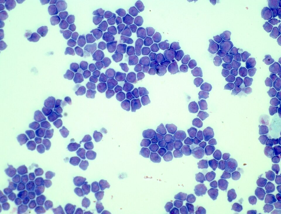 Acute Myeloid Leukaemia (AML) cells under a microscope
